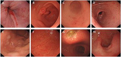 Correlation analysis of endoscopic manifestations and eradication effect of Helicobacter pylori